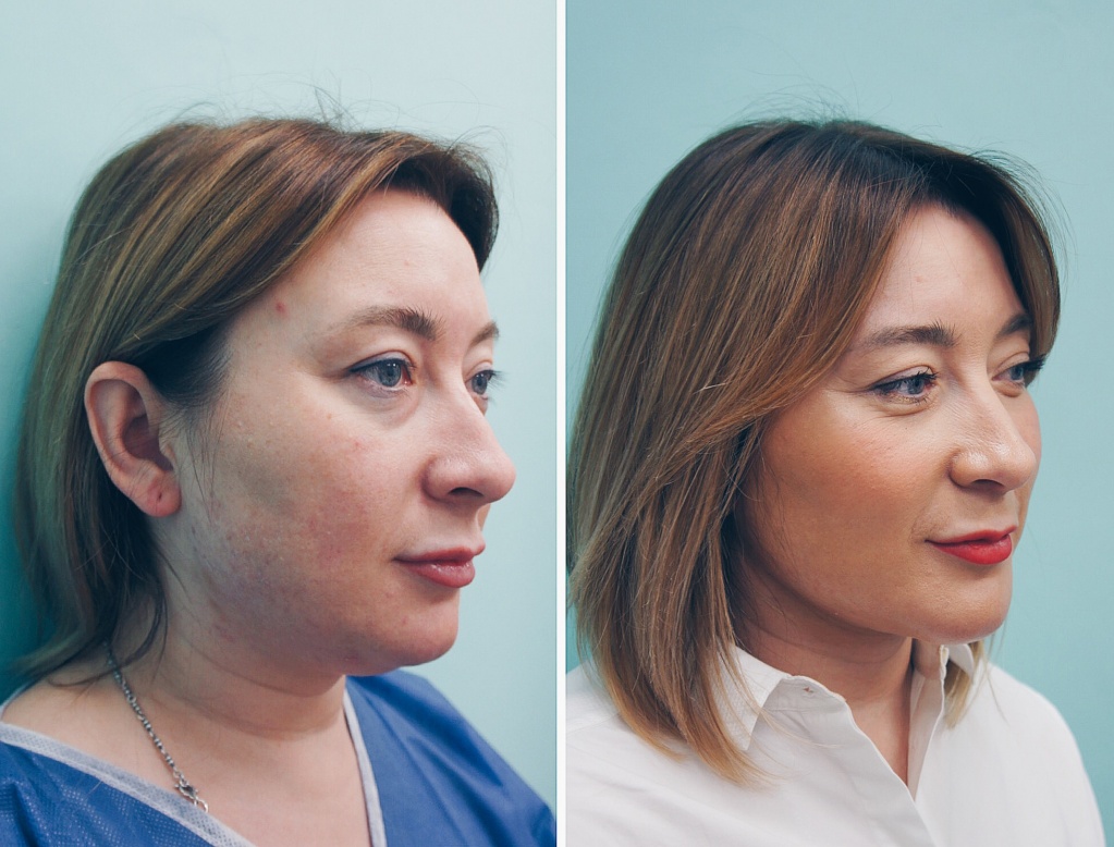 Кавитация для лица фото до и после