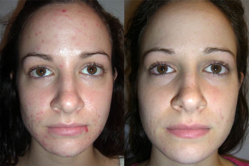 Кислотный пилинг для лица фото до и после