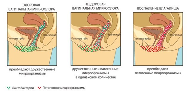 Схематическое отображение вагинального дисбактериоза