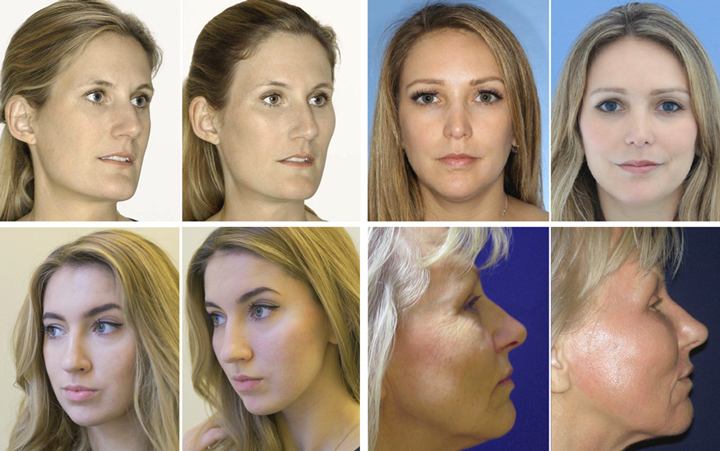 Сайт о красоте и здоровье!,Филлеры в скулы описание процедуры, фото до и после