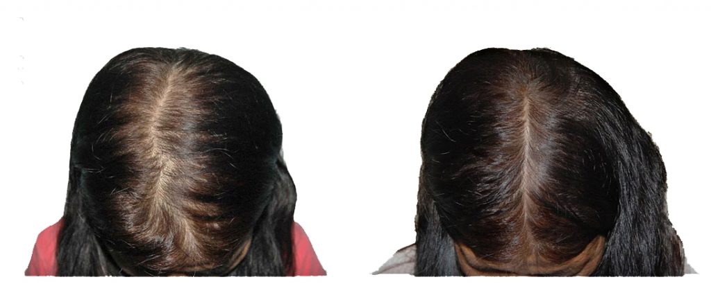 Маска против выпадения волос до и после