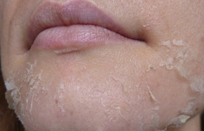 Проявления сухой себореи на лице
