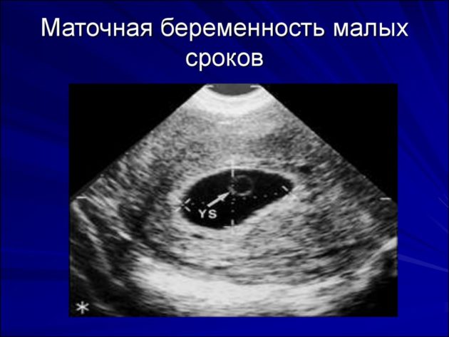 Мифепристон: отзывы при прерывании беременности и инструкция