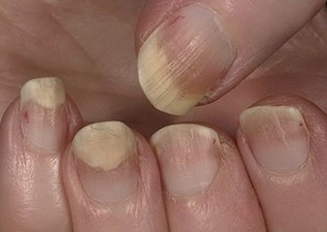 Поврежденные онихолизисом ногти утолщаются, становятся хрупкими
