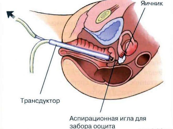 Взятие пункции кисты яичника