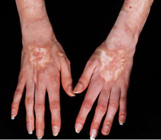 Пятна склеродермии отличаются от всей кожи по цвету и текстуре