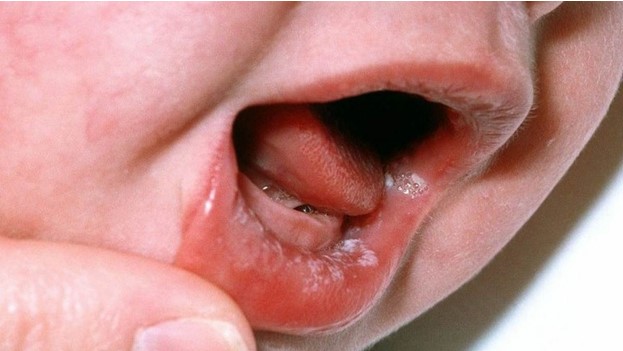 Первый признак кандидоза – пятна во рту, покрытые белым налетом