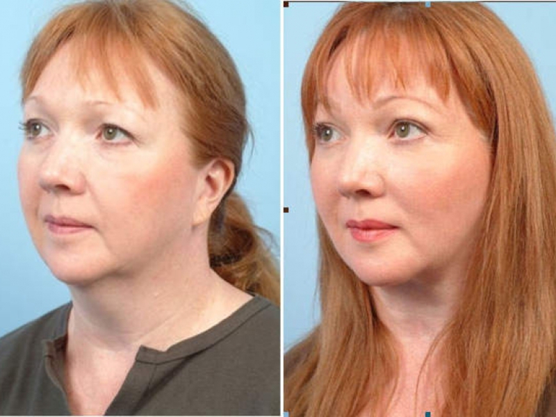 Убрать второй подбородок косметология уколы фото до и после