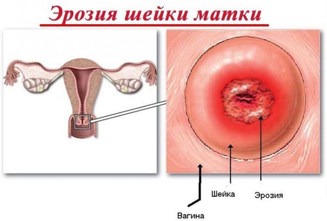 Эрозия шейки матки как причина задержки менструации