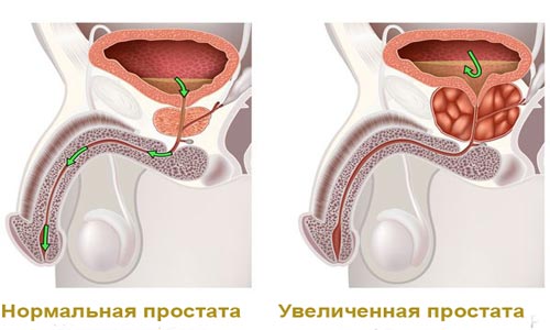 Нормальная и увеличенная простата