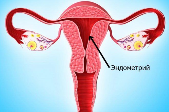 Отслоение эндометрия
