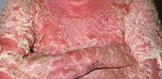 При запущенном псориазе шелушится в все тело, кожа постоянно воспалена