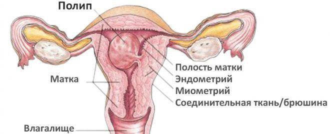 Полипы эндометрия