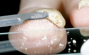 Забор частиц ногтя на микроскопию