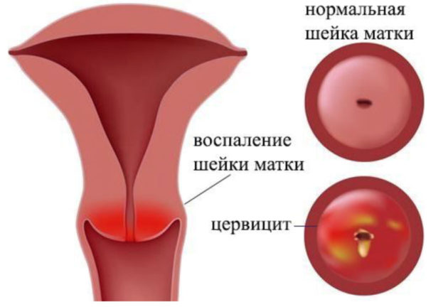 Антибиотики при хламидиозе: схема лечения для женщин и мужчин