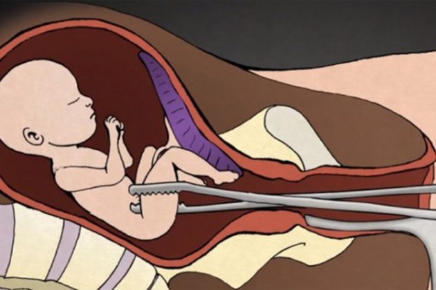 Способы прерывания беременности