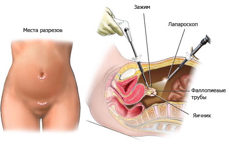 Беременность после лапароскопии яичников