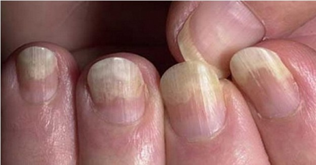 При грибке ногтей потребуется длительный курс лечения