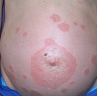 Во время беременности есть риск первого проявления псориаза