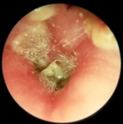 Грибковое поражение внутренних слуховых проходов
