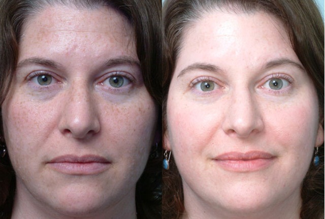 Кислотный пилинг для лица фото до и после