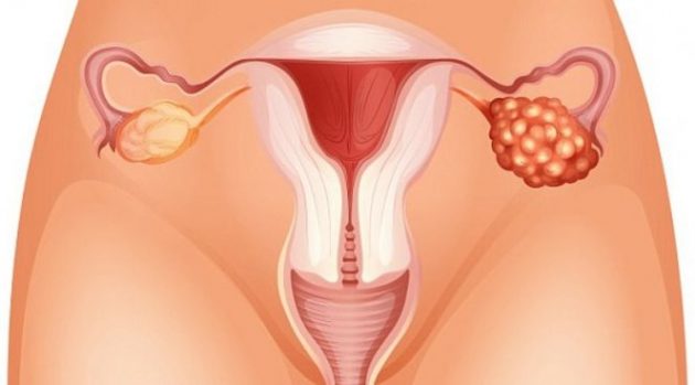 Причины увеличения яичника у женщин