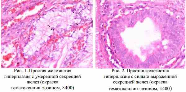Сложная гиперплазия эндометрия