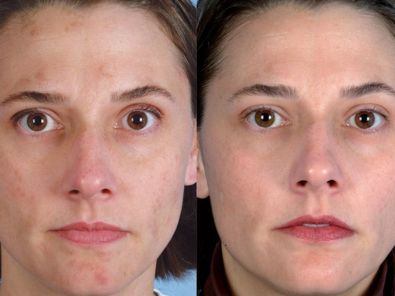 вакуумная чистка лица фото до и после