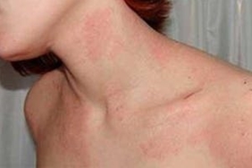 Аллергические пятна шелушатся во время восстановления кожи