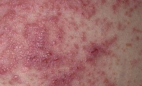 Молочница может спровоцировать аллергическую сыпь на коже