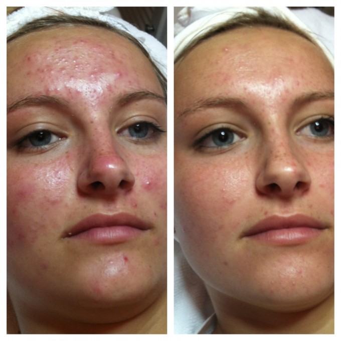 криотерапия лица фото до и после
