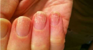 Измененные ногти при начальных стадиях онихомикоза