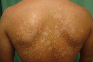 Пигментация кожи поле лечения лишая