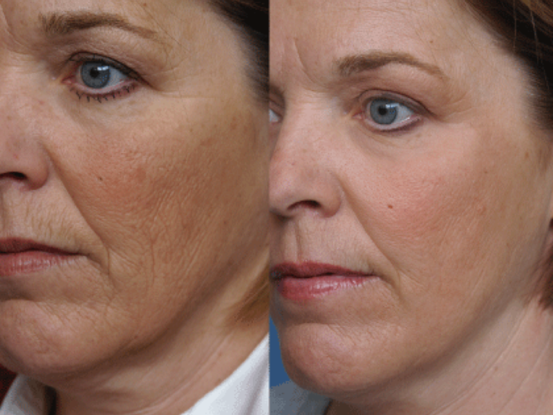 Плазмолифтинг лица фото до и после