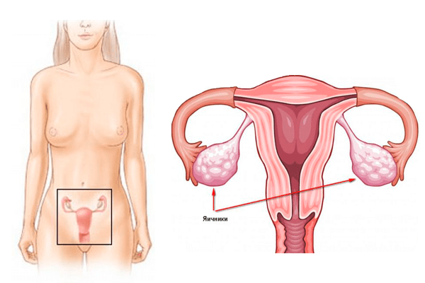 Причины увеличения яичника у женщин