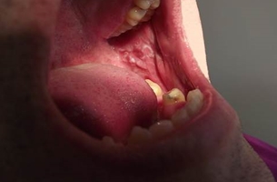 Поражение полости рта, эрозивно-язвенная форма