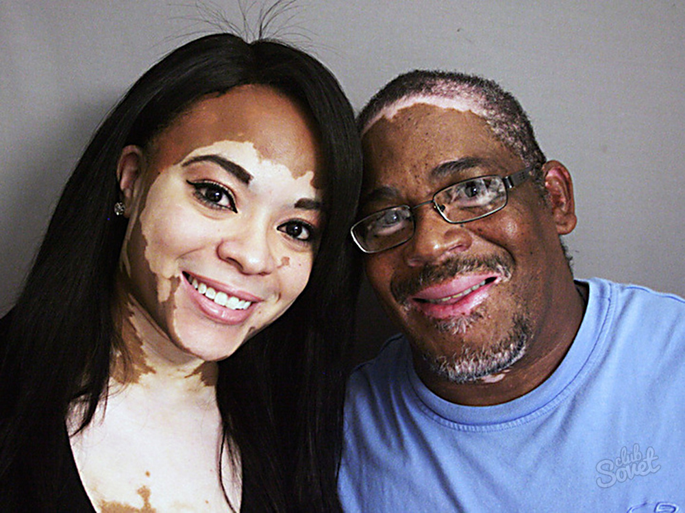 vitiligo-lechenie