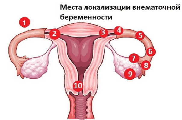 Месячные при внематочной беременности