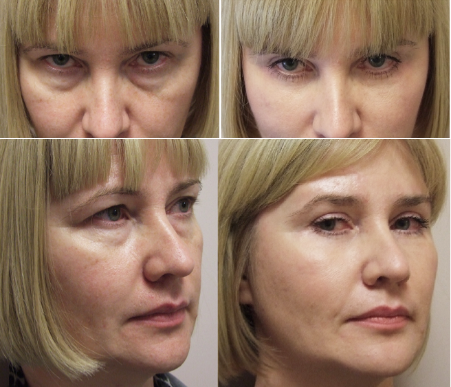 Мезотерапия для лица инъекционная до и после фото вокруг глаз
