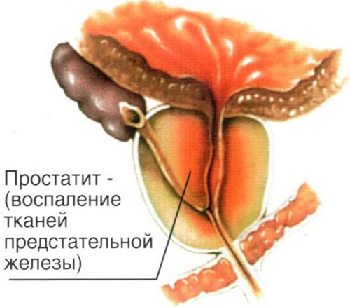 Схема воспаление предстательной железы