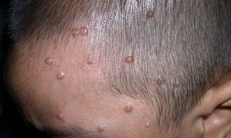 Элементы моллюска могут появляться на волосистых участках кожи