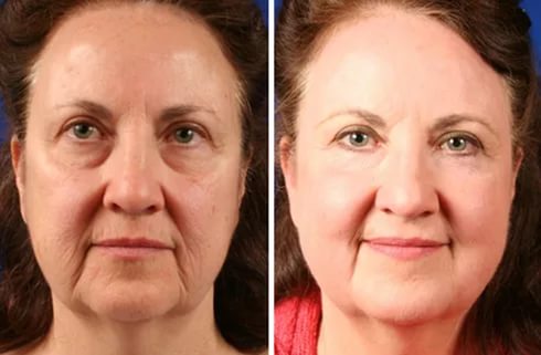 Фотоомоложение лица до и после