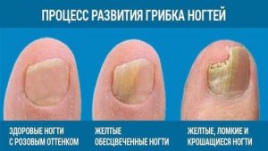Стадии развития грибка ногтей