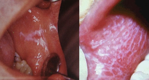 Типичные поражения красным плоским лишаем в полости рта