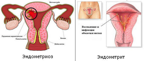 Эндометрит и эндометриоз