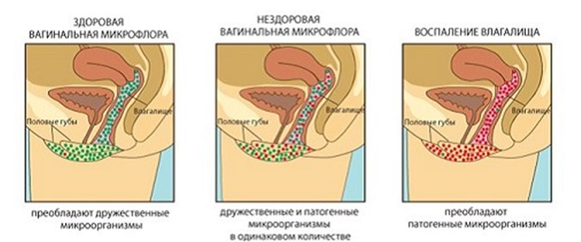 Кандидоз развивается, если нормальную микрофлору влагалища вытесняют грибки