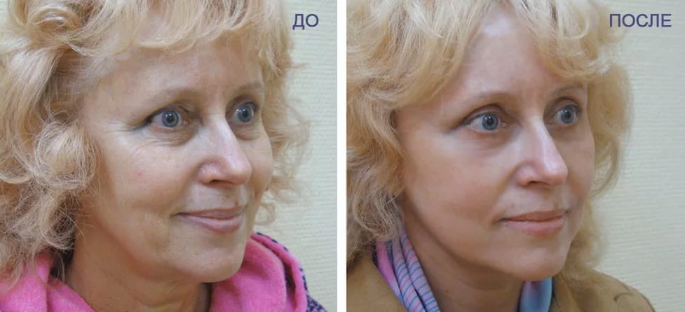 Плазмолифтинг лица фото до и после