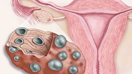 Поликистоз яичников: симптомы и лечение народными средствами