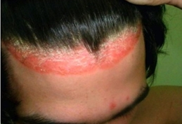 Псориаз может распространяться на кожу лица