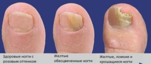 Процесс развития грибка ногтей